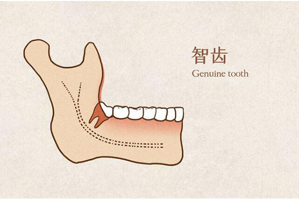中位阻生牙为什么比高位阻生牙还要贵些(中位阻生牙好拔吗)
