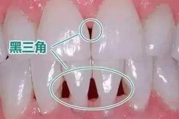 50岁女人牙龈萎缩能恢复吗(50岁女人牙龈萎缩能恢复吗图片)