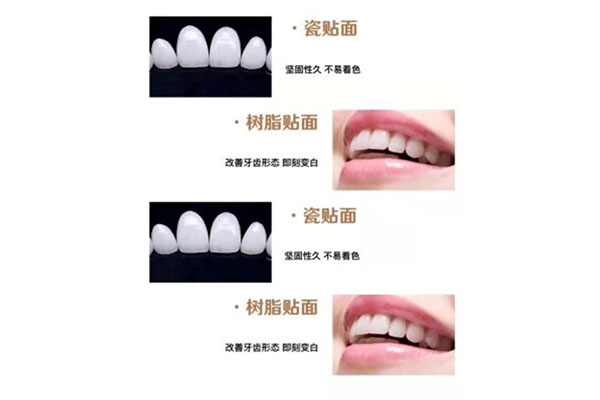 全瓷牙和牙齿贴面(全瓷牙和牙齿贴面的区别)
