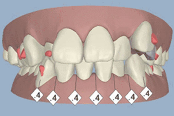 小孩牙齿不齐几岁可以矫正好(小孩牙齿不齐几岁矫正最好)全程珍贵知识