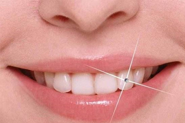 冷光美白好不好(冷光美白好不好做)