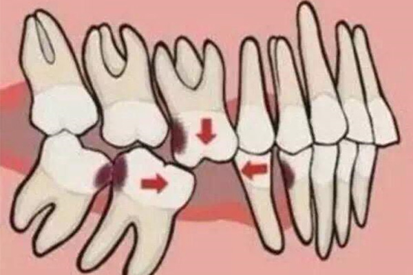 形容龅牙的词语(形容牙齿龅牙的词语)