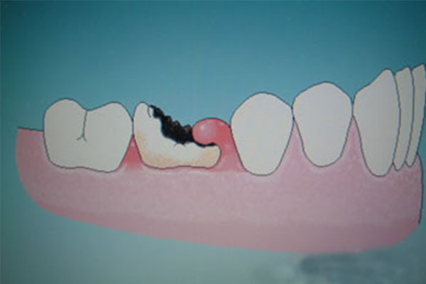 牙体缺损病例分析题及答案解析(牙体缺损病例分析题及答案解析图)