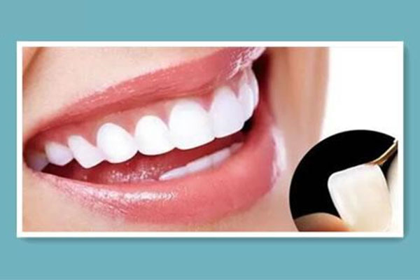 做牙贴面要多久(做牙贴面要多久才能做好)