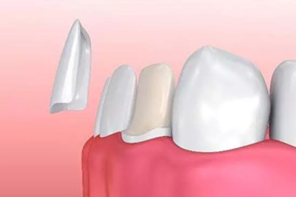 做贴面牙齿多少钱一颗(牙齿贴面能保持几年)