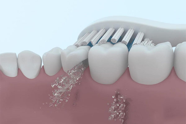 为什么私立医院洗牙便宜很多(为什么私立医院洗牙便宜很多钱)