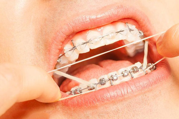 牙列拥挤程度分级(牙列拥挤度分类)