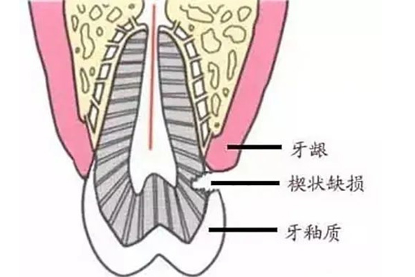 牙体缺损粘贴修复术多少钱(牙体缺损