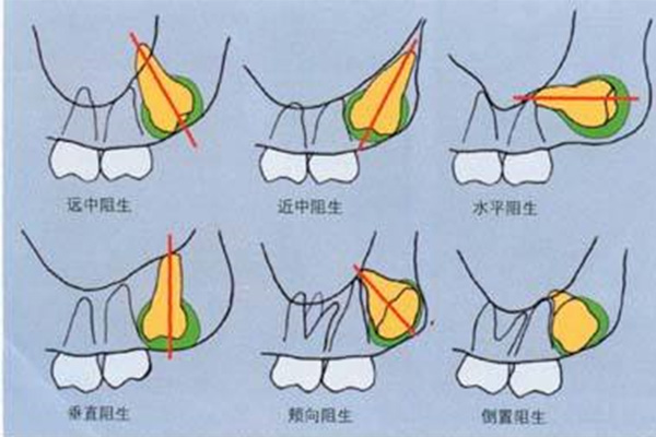 下智齿拔牙费用多少(下智齿拔牙费用