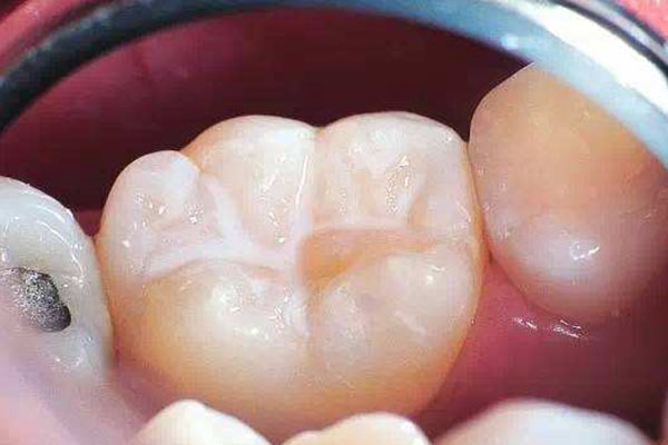 lcm树脂补牙(树脂补牙a1)