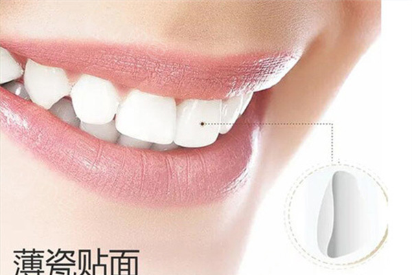 做牙贴面多少钱可以维持多久啊(做牙贴面多少钱可以维持多久啊视频)