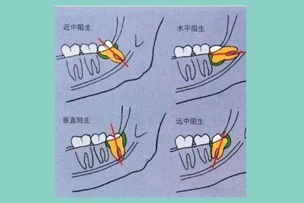 上颌的智齿拔了之后下颌的智齿(上颌的智齿拔了之后下颌的智齿