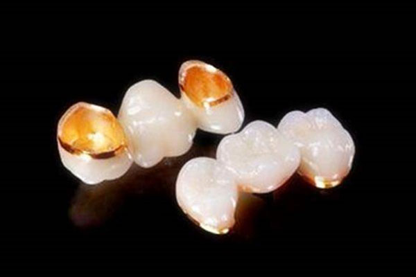 不是金属的烤瓷牙多少钱(非金属烤瓷