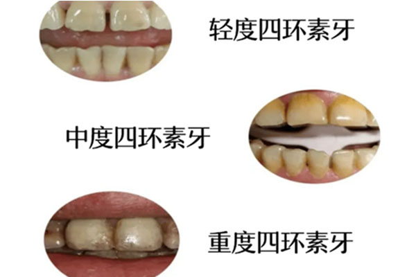 四环素为什么不可以用于8岁以下小儿急疹(四环素为什么不可以