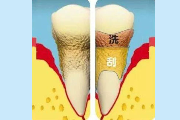 下牙牙龈萎缩严重会怎么样吗(下牙牙