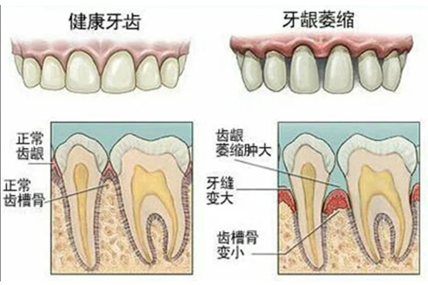 下牙齿牙龈萎缩是什么样子(下牙齿牙龈萎缩怎么办)