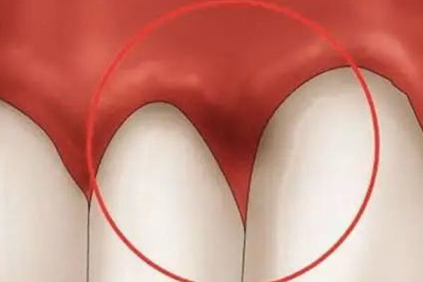 三十几岁牙龈萎缩严重怎么办呀怎么治疗(三十几岁牙龈萎缩严重