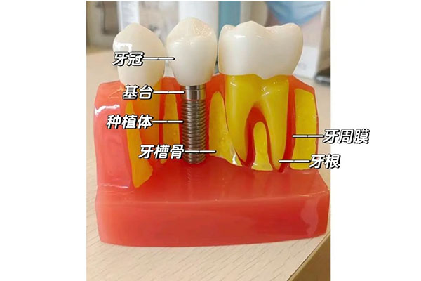 “种牙多少钱一颗”(种牙多少钱一颗