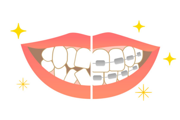 小孩龅牙怎么治疗(小孩子礳牙要怎么治疗)