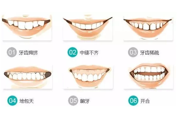 牙不齐做全瓷好还是矫正好(牙不齐做