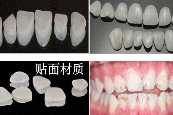 做牙贴面价格一般多少 烤瓷牙好呢(做牙贴面价格一般多少 烤瓷