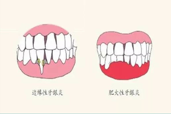 专治牙龈萎缩