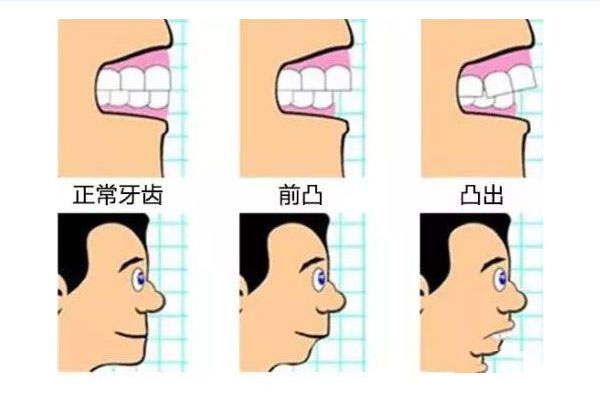 一周岁宝宝牙齿地包天怎么办