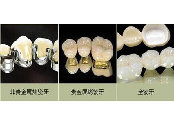 做一口烤瓷牙要多少钱一颗呢(做一口