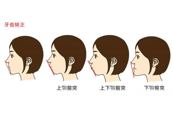牙弓拥挤度定义(牙弓拥挤度定义是什