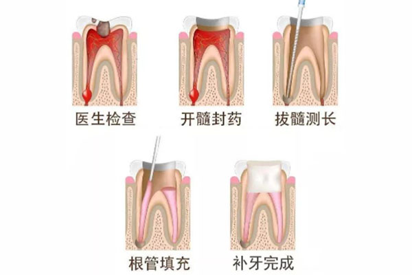 三岁牙齿坏了要补么(三岁牙齿坏了要补么还是拔掉)