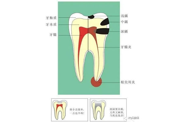 46根尖炎是什么(46根尖周炎严重不)