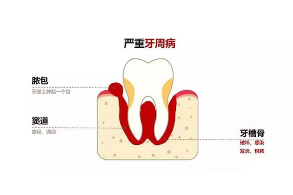 今天洗牙了牙周炎很严重医生说要分