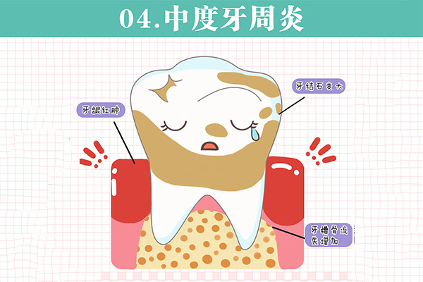 中度牙周炎到重度牙周炎要多长时间