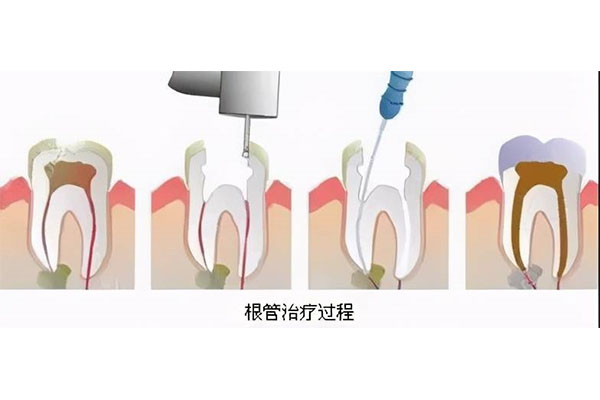 上海医院根管治疗多少钱(上海医院根管治疗多少钱一颗牙)