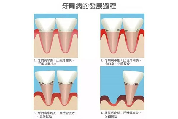 中药治疗牙周病(中药治疗牙周病有哪