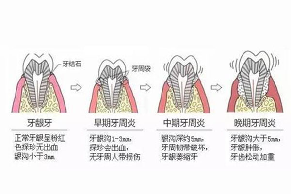 什么情况是牙周炎