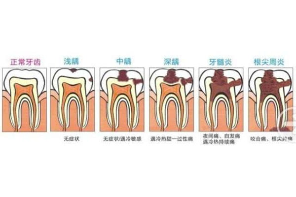 乳牙根尖炎怎么治疗最好呢播放(乳牙