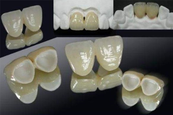 全瓷冠修复前后的照片(全瓷冠修复流