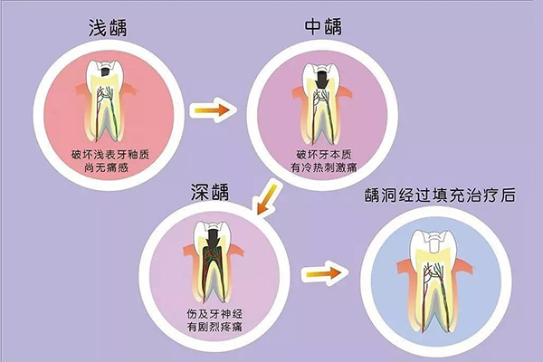 3岁孩子蛀牙有洞怎么办,还没换牙(3岁