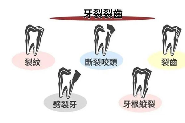 牙齿楔状缺损和好的牙齿的(牙齿楔状