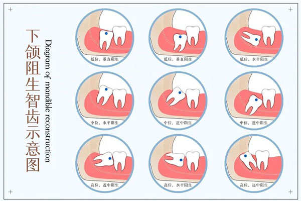 什么时候拔智齿(什么时候拔智齿最好早上还是下午)