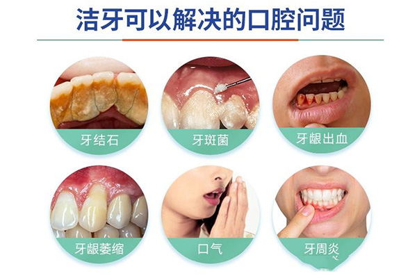 洁牙后喷砂的作用与用途有哪些(洁牙