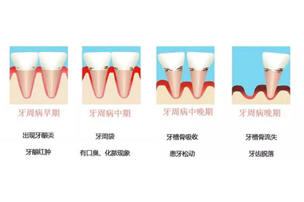 中度牙周病怎么治疗最好(中度牙周病