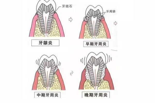 为什么要洗牙周