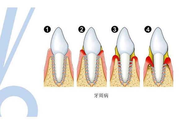 为什么牙周炎得上就是终身的