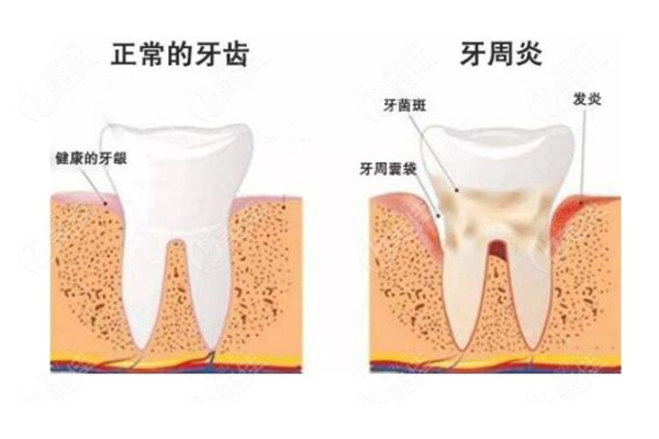 中度牙周炎治疗后可维持几年(重度牙
