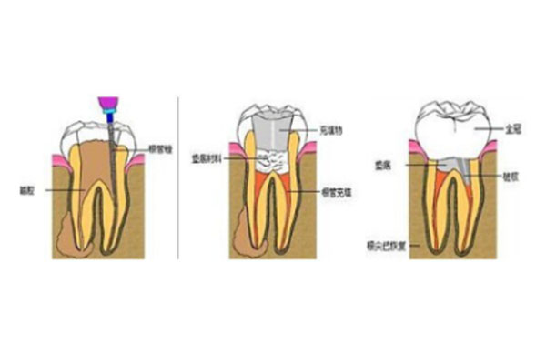 上海做根管治疗可以用医保吗报销吗