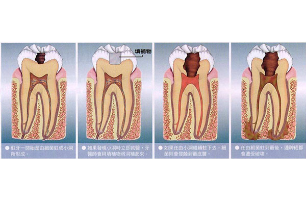 3岁宝宝蛀牙怎么办有洞了经常牙痛吃什么药(3岁宝宝蛀牙怎么办