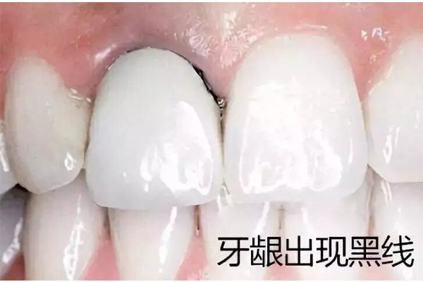 中医怎么看待牙龈萎缩症状(中医怎么看待牙龈萎缩症状图片)
