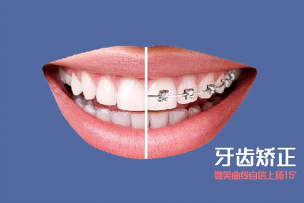 牙齿龅牙矫正费用(牙齿龅牙矫正要多